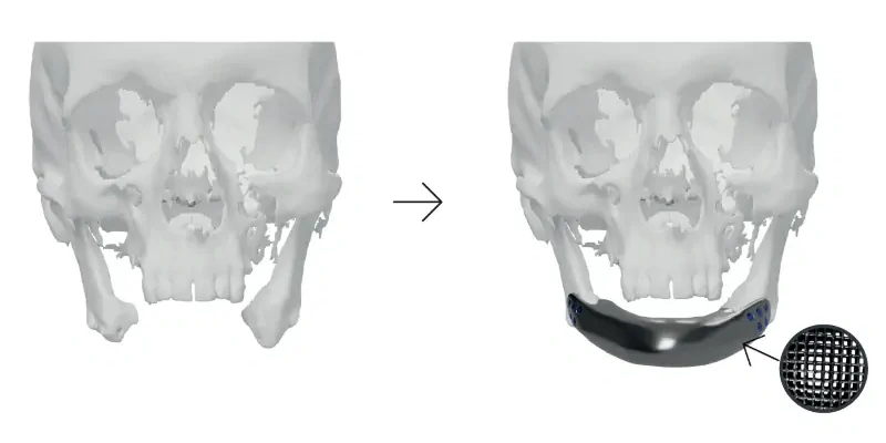 Reconstruction of the mandible using an individual bone implant with an internal scaffold, designed for optimal bone ingrowth and solid osseointegration 
