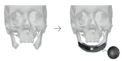 Reconstruction of the mandible using a 3D printed titanium implant with mesh scaffold 