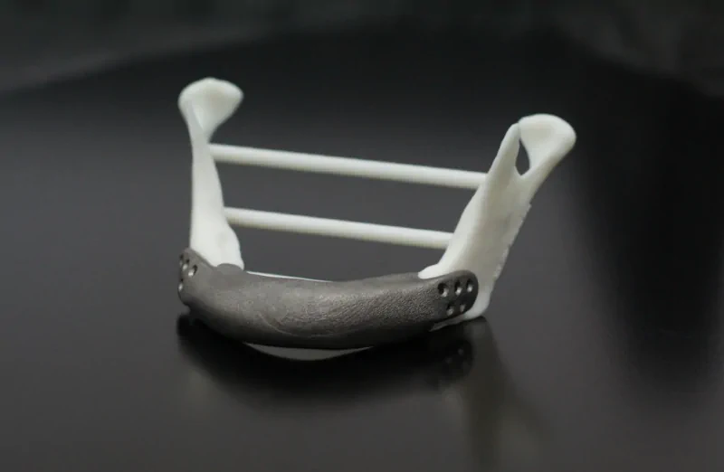 The titanium implant positioned on the model of the patient's mandible