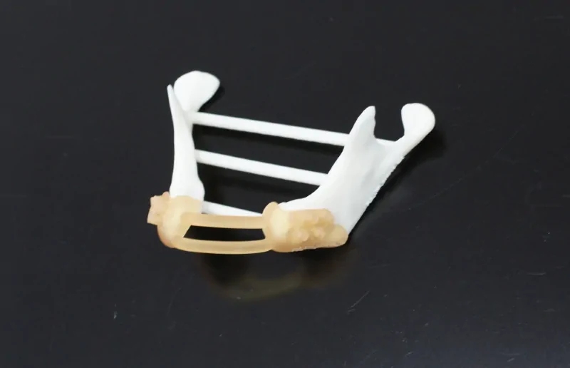 The surgical guide positioned on the model of the patient's mandible