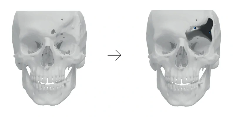 Reconstruction of the acquired frontal bone defect conducted to restore the patient face symmetry. 