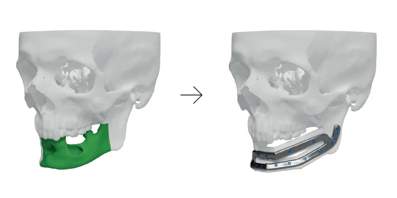 Mandibular tumour resection and reconstruction using double-barrel free vascularized fibula flap with a customized titanium plate 