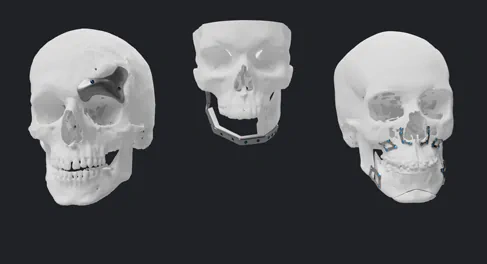 Craniofacial