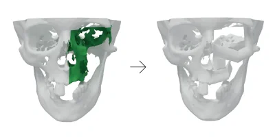 Middle face reconstruction using patient-specific surgical guides and vascularized free fibula flap 