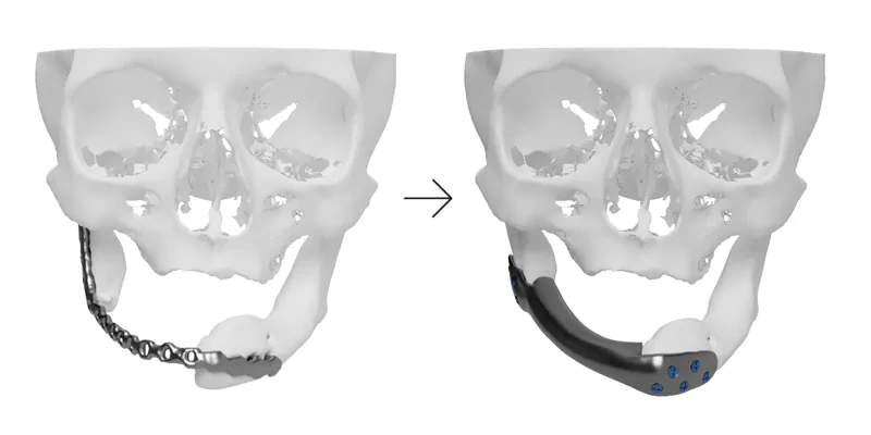 Reconstruction of the mandible using an individual bone implant with an internal scaffold, designed for optimal bone ingrowth and solid osseointegration 