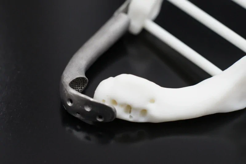 The patient-specific titanium implant with the anatomical model of the mandible