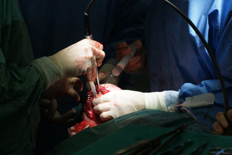 Drilling implant holes using the custom surgical drilling guide