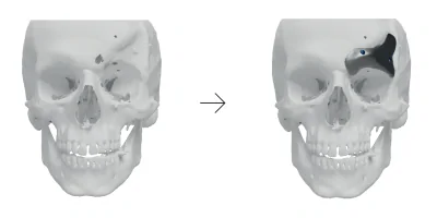 Reconstruction of the acquired frontal bone defect using a 3D printed titanium implant 