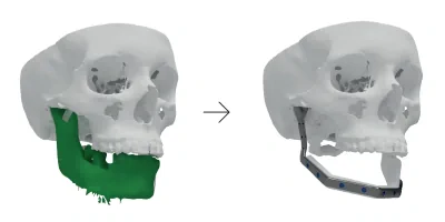 Extensive reconstruction of 65% of the mandible using a custom-made 3D printed plate and vascularized free fibula flap 