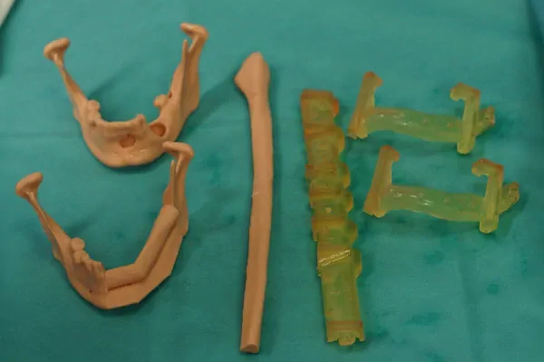 Harvesting fibula bone grafts using the patient-specific surgical cutting guide